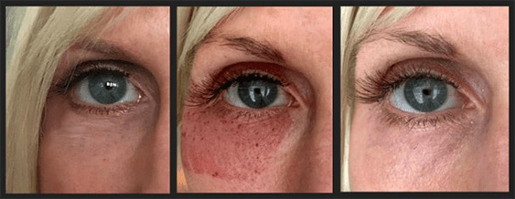 Treatment for cure of rash under eye