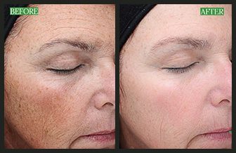 Face treatment before and after