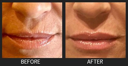 Treatment near lips before and after