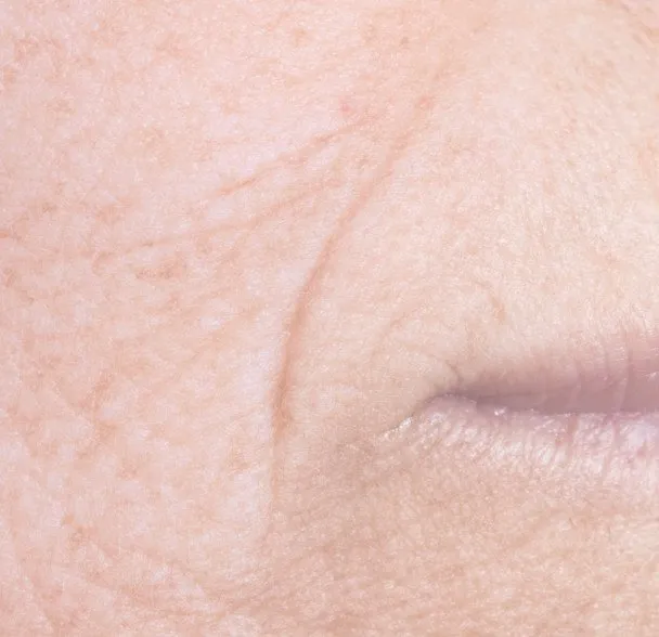 Deep wrinkles and expression lines around mouth