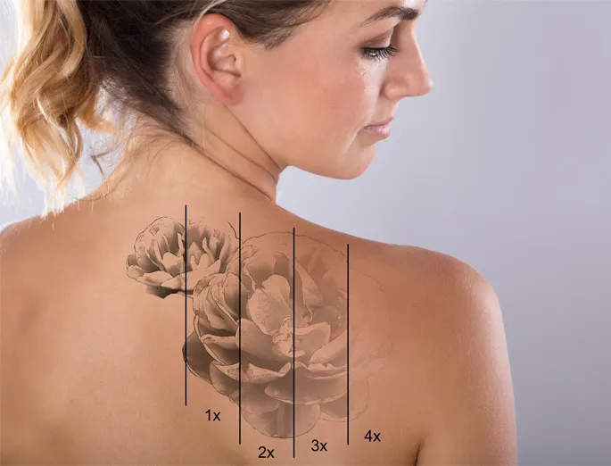 Picosecond laser tattoo removal technology