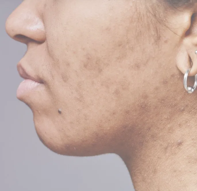 Facial hyperpigmentation and melasma on cheek and jawline