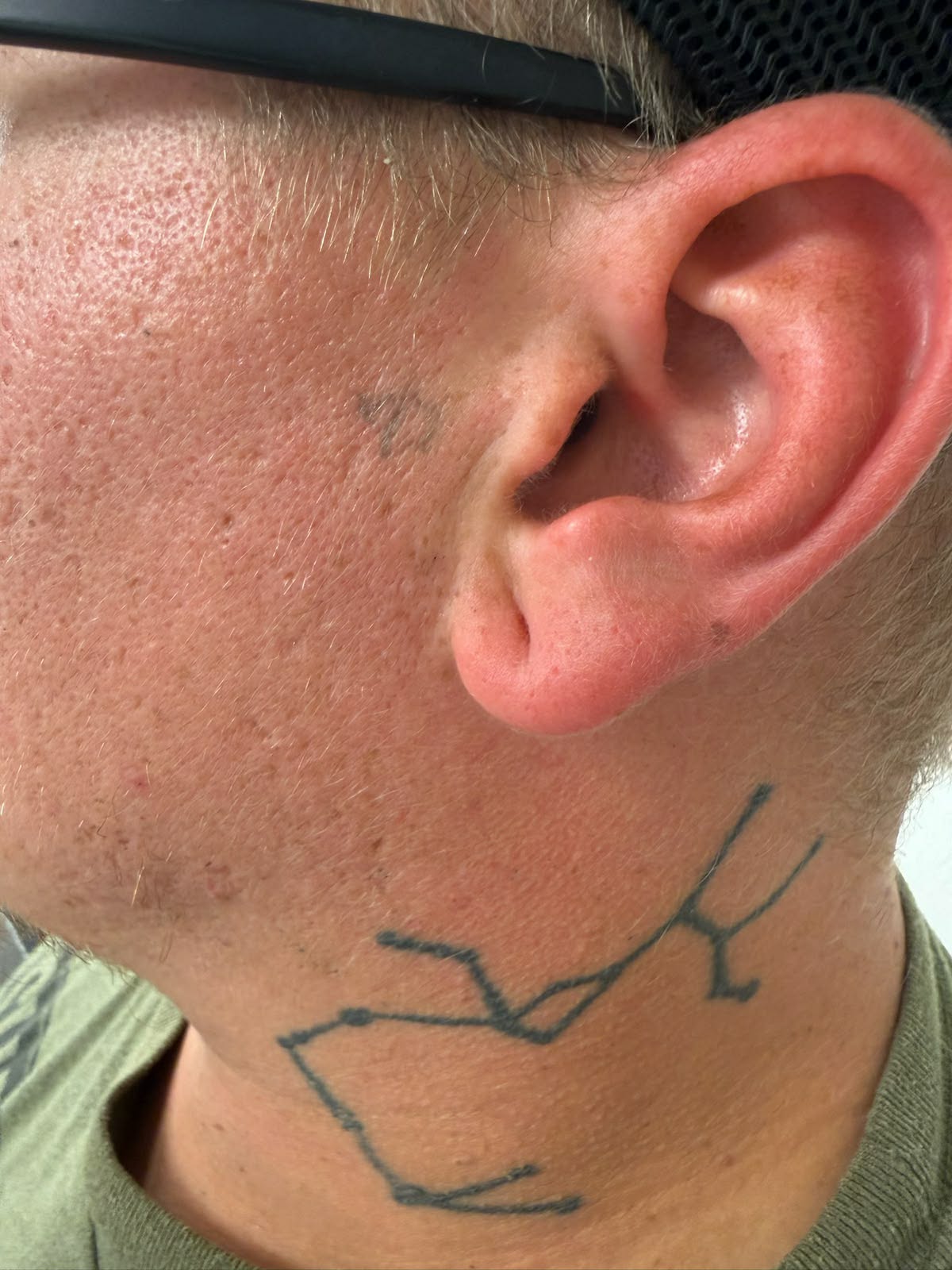 After 2 sessions of laser tattoo removal, neck and jaw tattoo