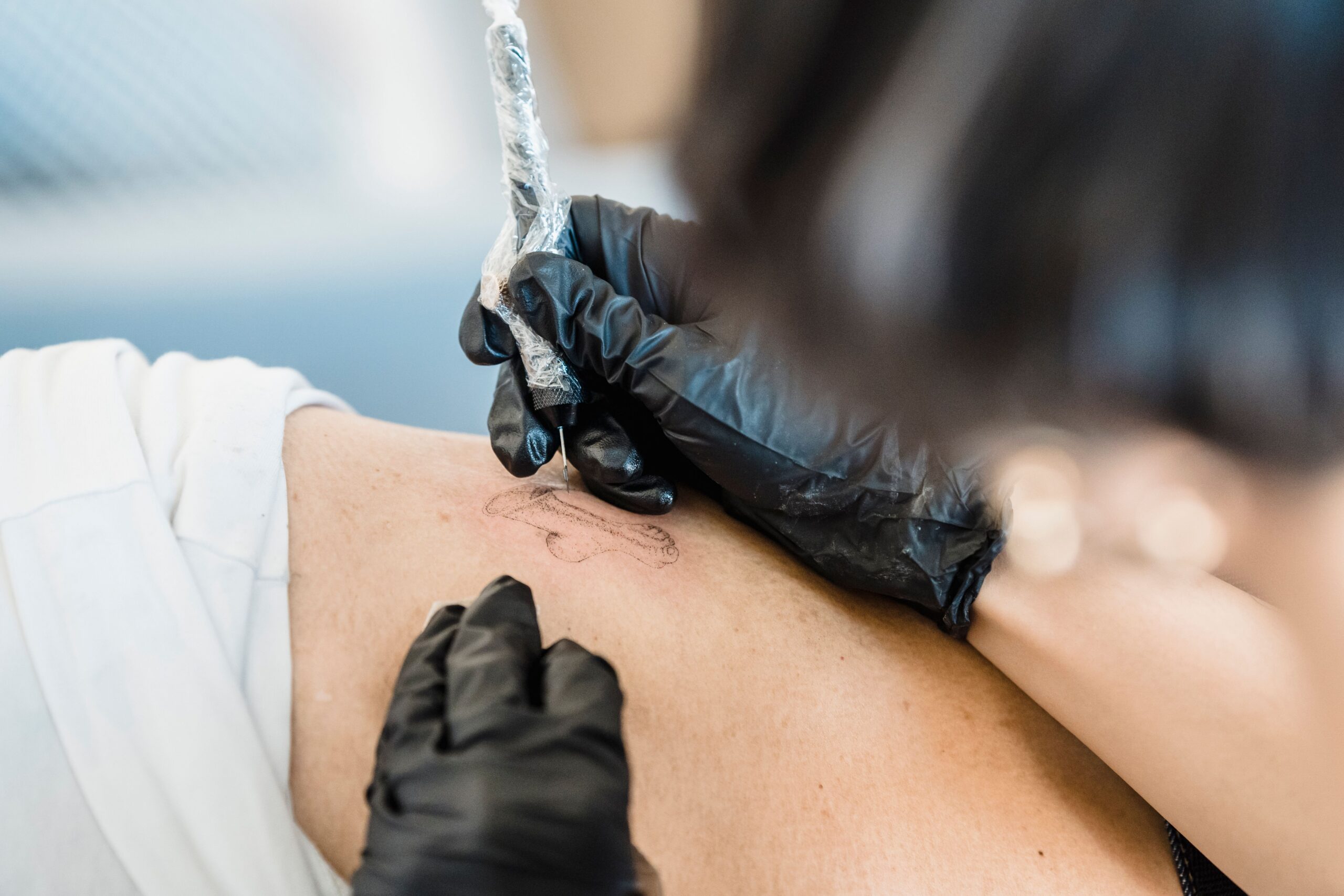 Laser tattoo removal treatment