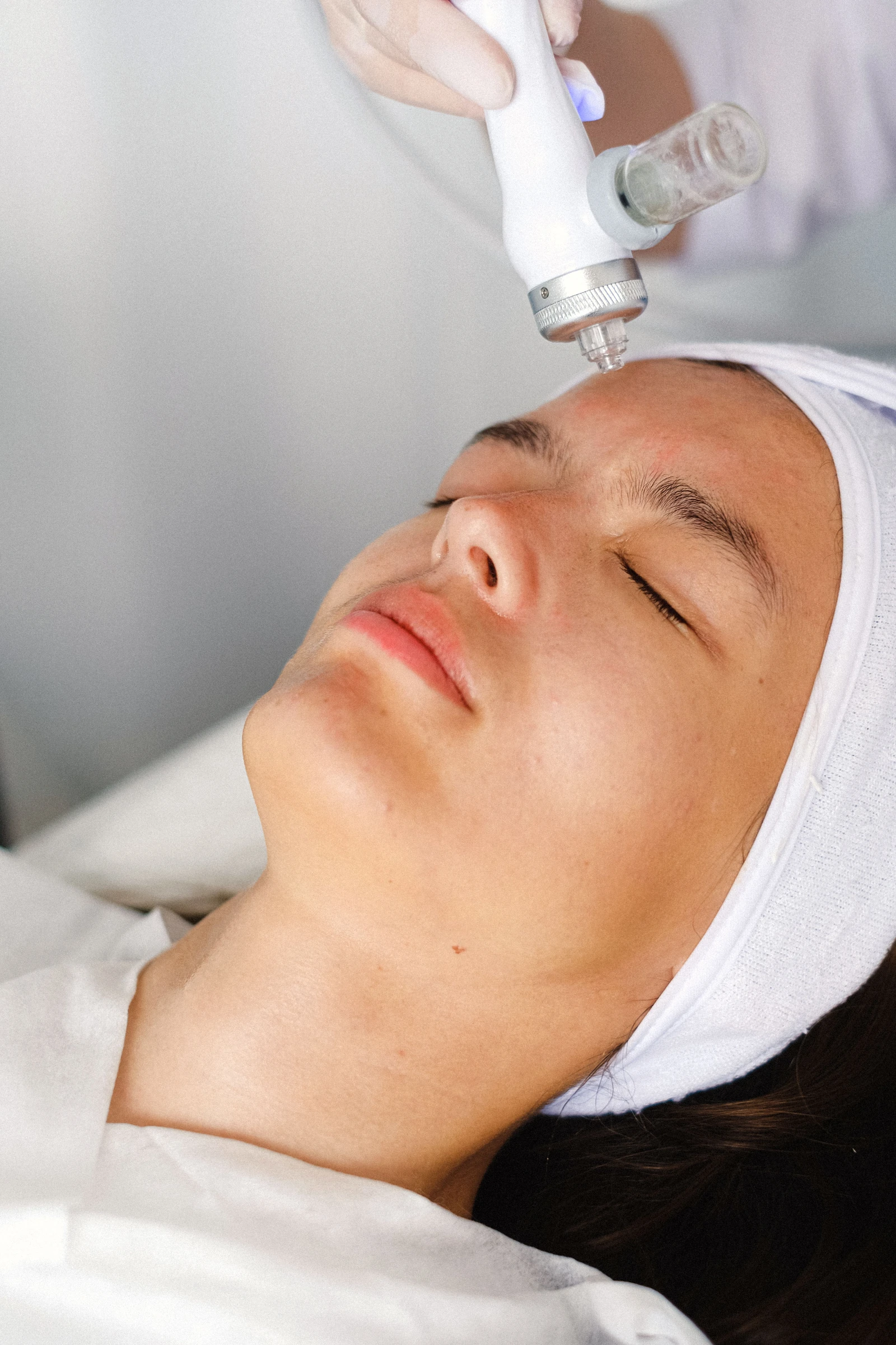 Microneedling and LaseMD skin reset treatment